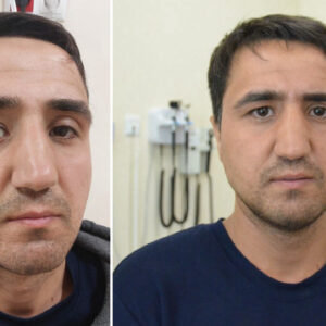 yuzundeki 15 yillik tumorden 5 saatte kurtuldu tjf3Fzw4